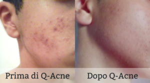 Q-Acne funziona